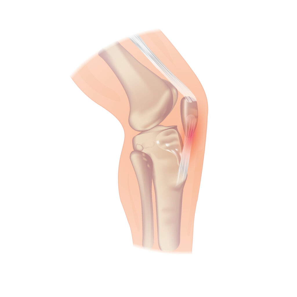 Pain in the soft tissue of the knee
