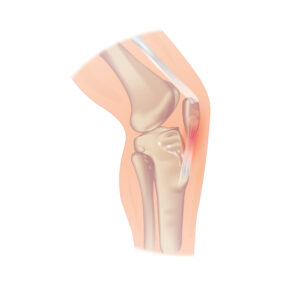 Pain in the soft tissue of the knee