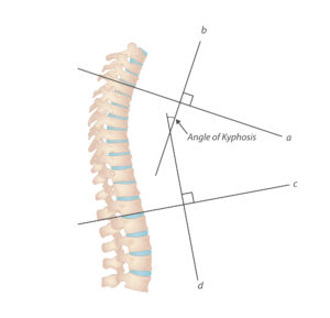 Measurement of kyphosis (Dowager's Hump)