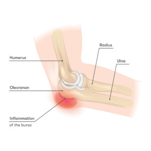 Elbow - Inflamation of the bursa