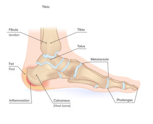 Inflammation in the heel