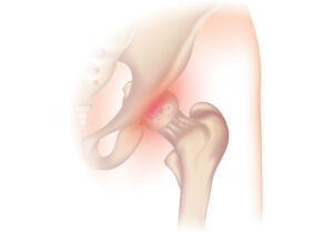 Pain in your hip joint