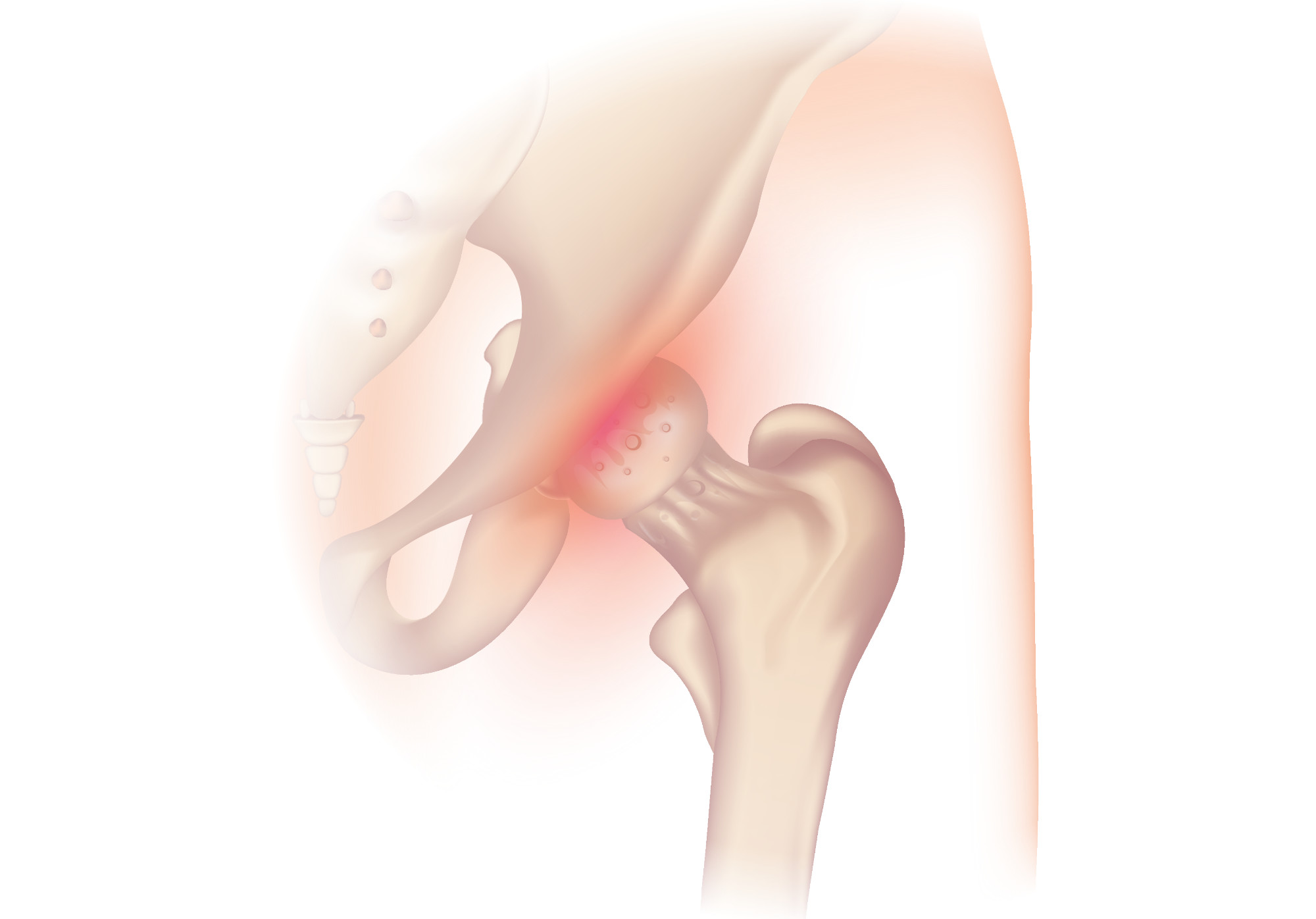 Osteoarthritis in the hip