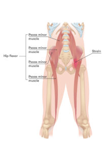 Hip flexor strain