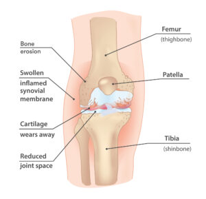 Injuries to the knee