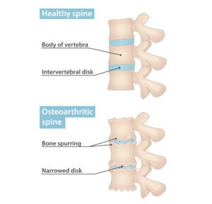 Osteoarthritic spine