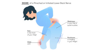 Signs of pinched nerve