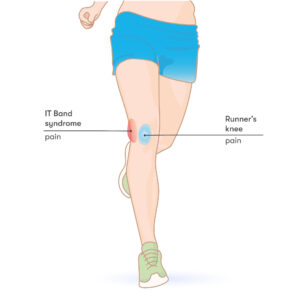 IT band syndrome vs Runner's knee