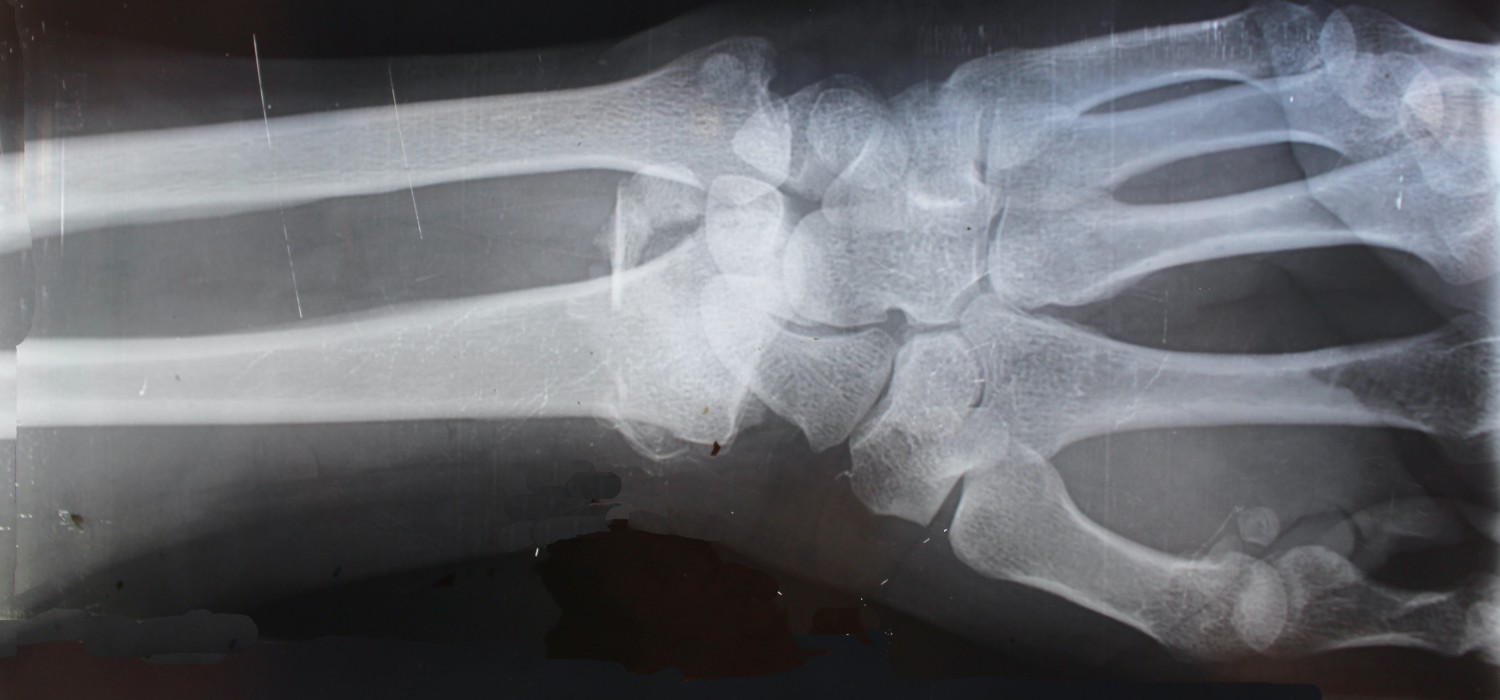 How can you tell if you have a bone spur and what should you do about it?