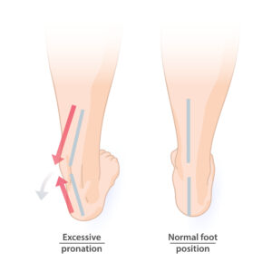 Pronation of the foot