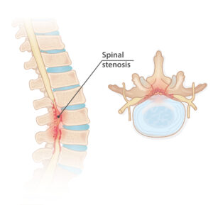 Spinal stenosis B