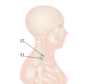 Cervicothoracic Junction