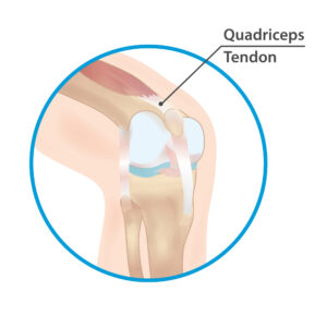 Quadriceps tendon